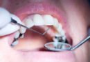 وزارة الصحّة: منع استعمال ملغم الأسنان في علاج أسنان الأطفال دون 15 سنة والنساء الحوامل والمرضعات !
